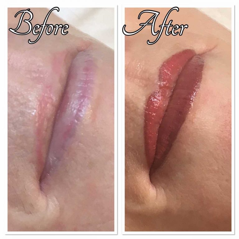 Permanent Lip Treatment Before and After Permanent Lip Treatment Before and After